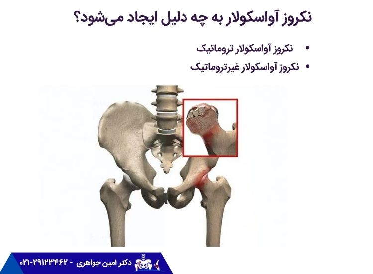 دلایل نکروز استخوان