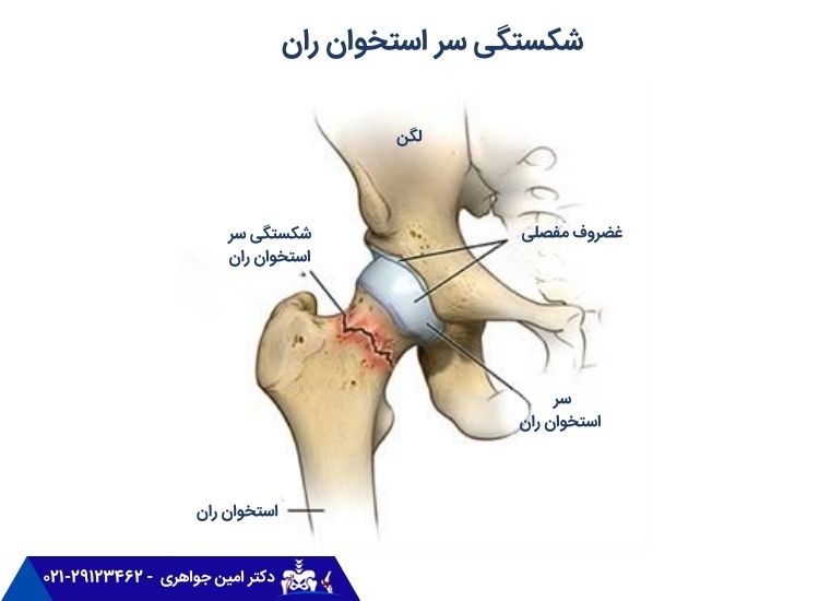 شکستگی سر استخوان ران