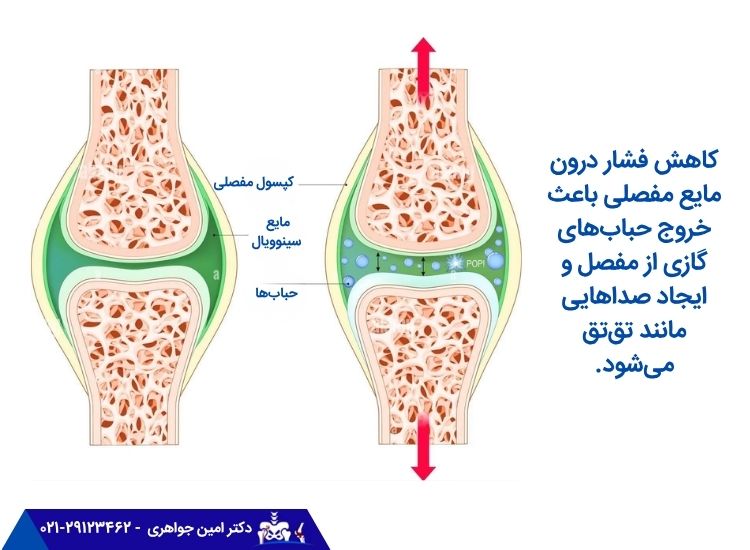 صدا دادن زانو به دلیل خروج حباب و گاز از مفصل