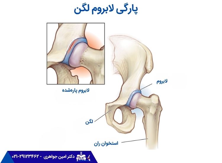 پارگی لابروم لگن