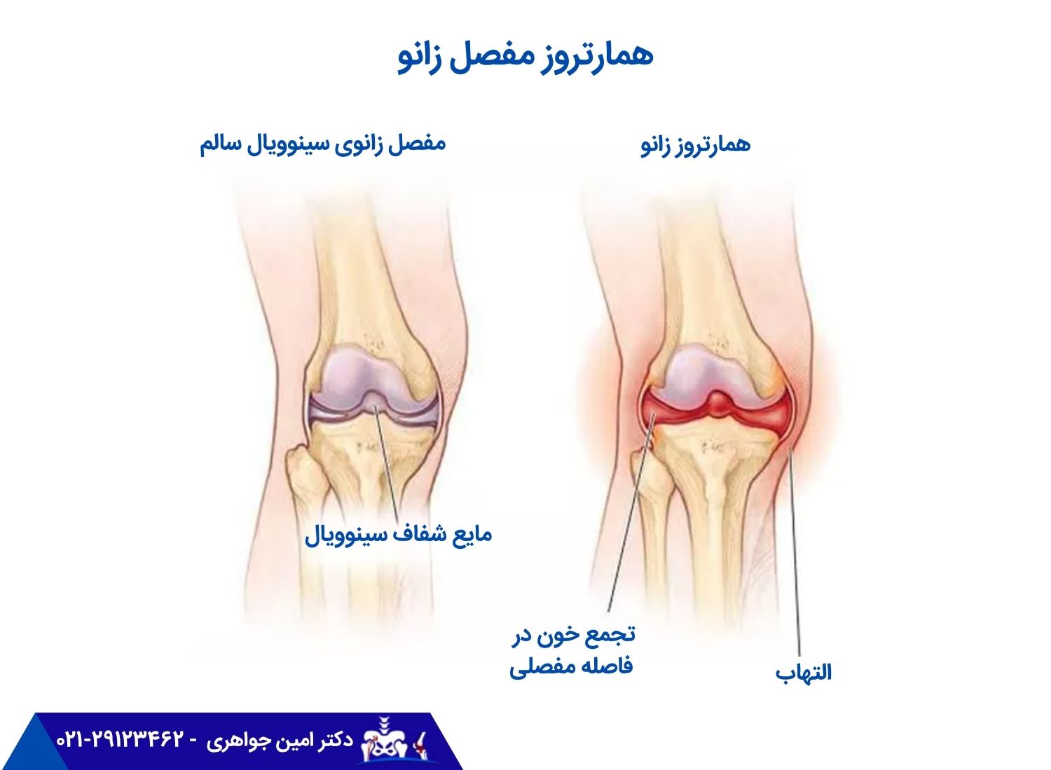 همارتروز زانو