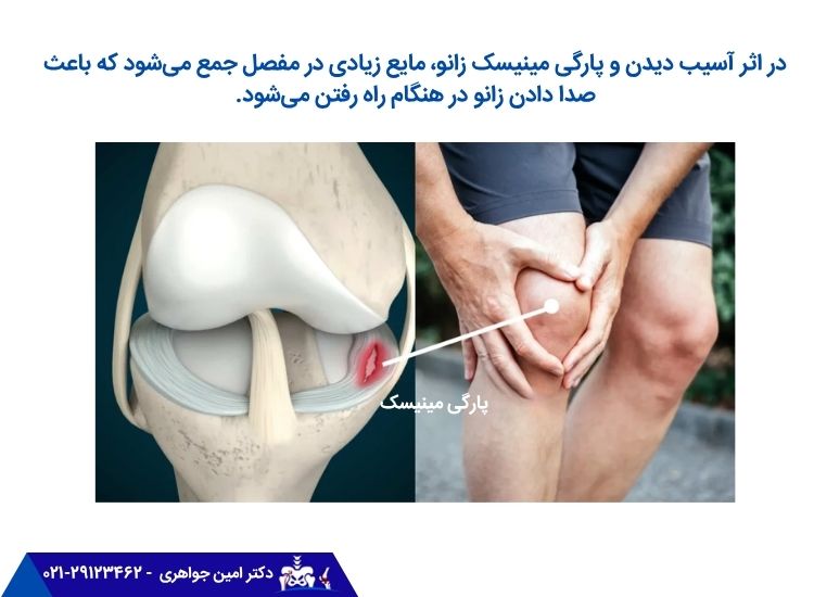 صدا دادن زانو بهدلیل پارگی مینیسک مفصل