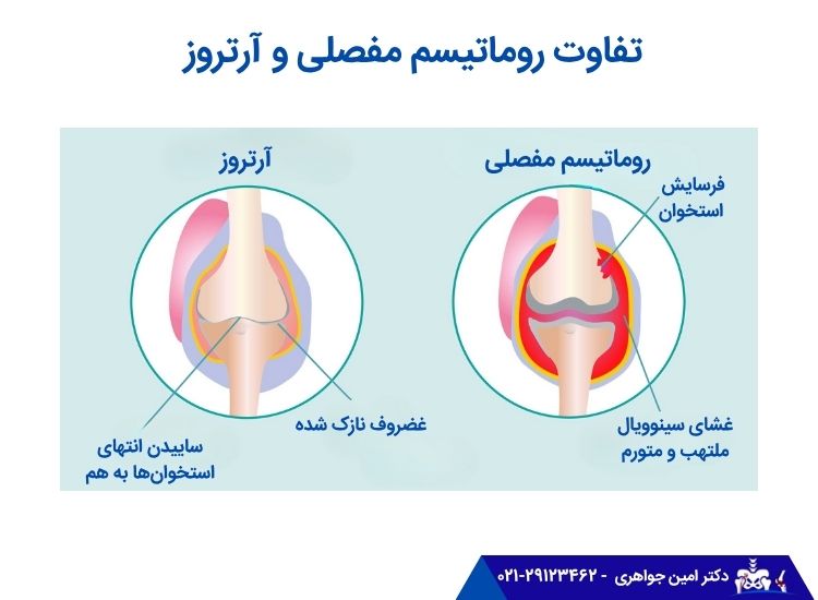 تفاوت روماتیسم مفصلی و آرتروز