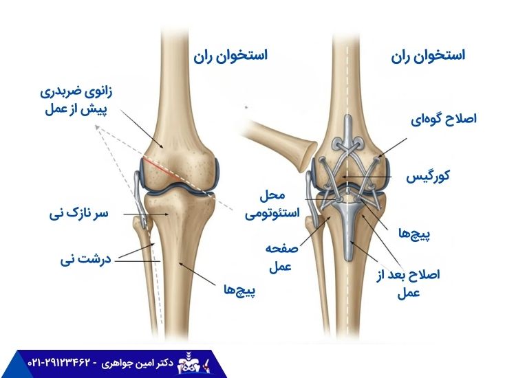 جراحی استئوتومی برای درمان پای ضربدری