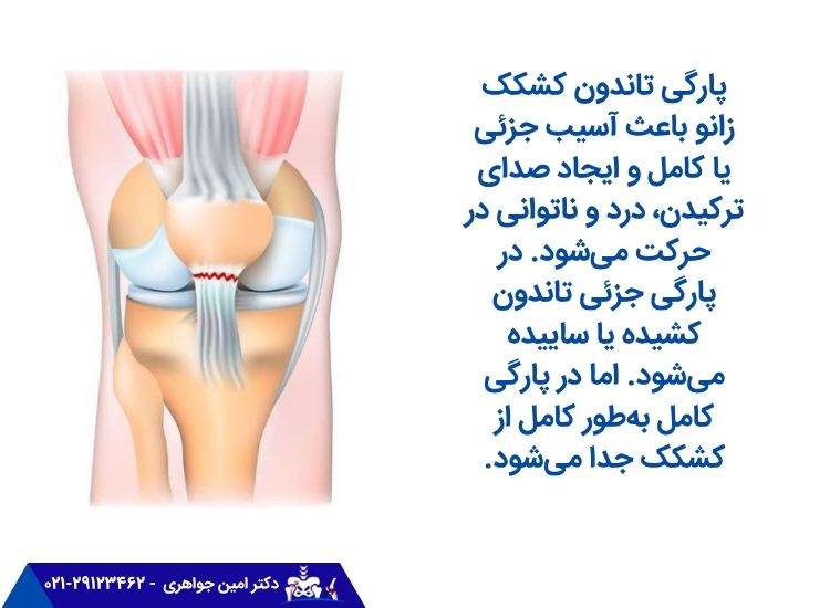 صدا دادن زانو به دلیل پارگی تاندون کشکک