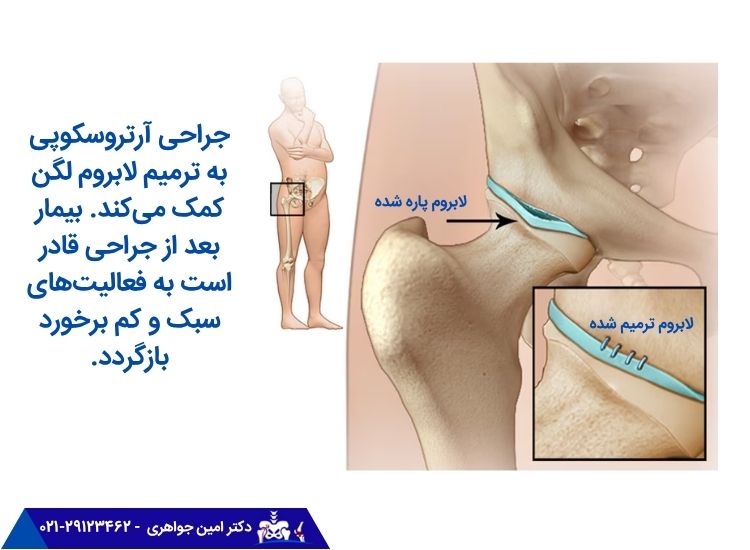 جراحی آرتروسکوپی به ترمیم لابروم لگن کمک میکند.