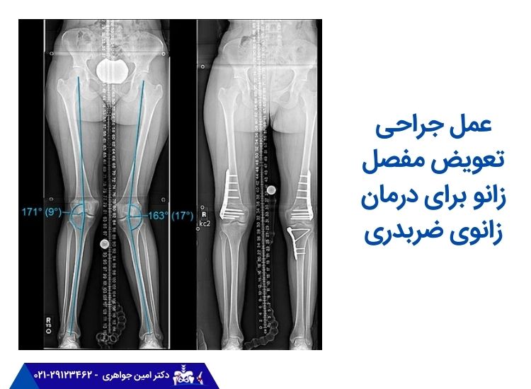 عمل جراحی تعویض مفصل زانو برای درمان پای ضربدری