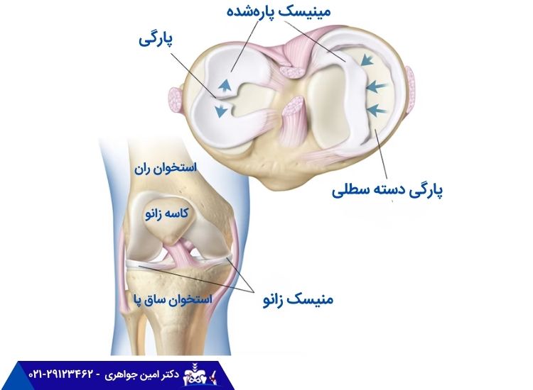 پارگی منیسک زانو