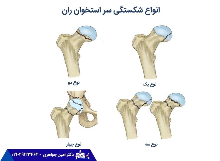انواع شکستگی سر استخوان ران
