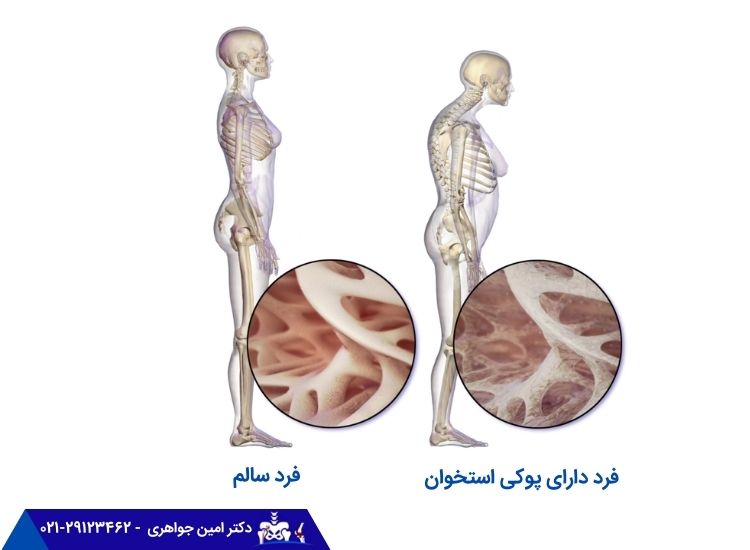 پوکی استخوان