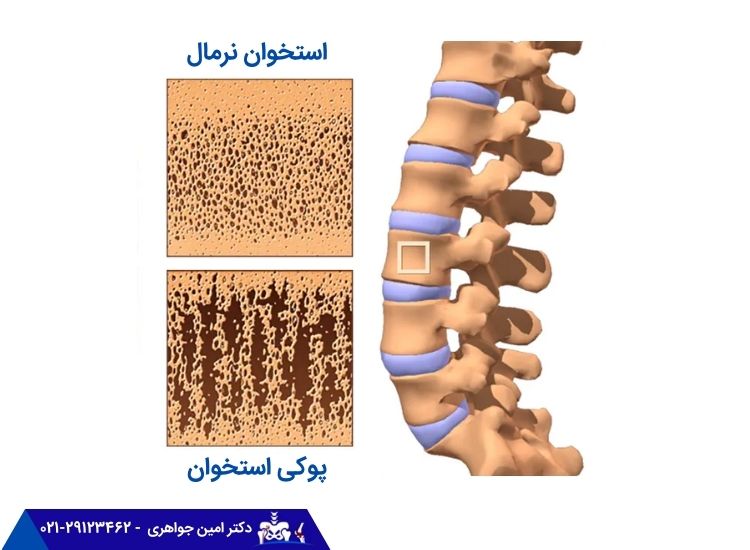 استخوان سالم و مبتلا به پوکی استخوان