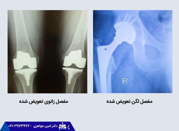 تعویض مفصل لگن و تعویض مفصل زانو