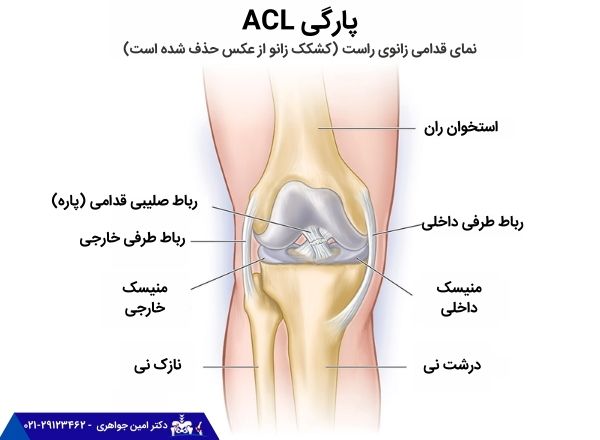 رباط صلیبی پاره