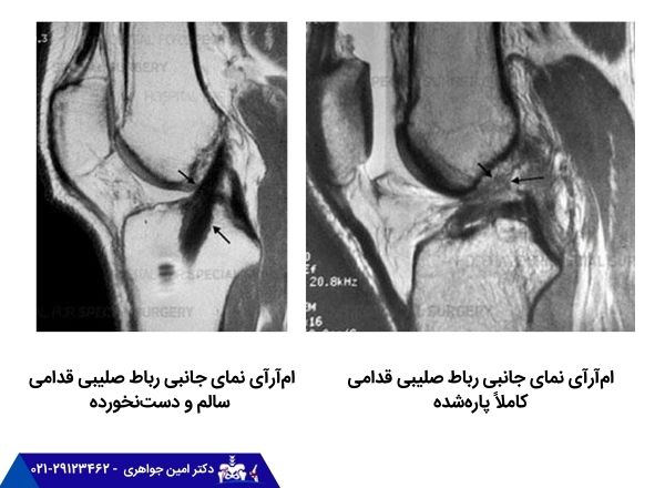 مقایسه ام‌آرآی نمای جانبی رباط صلیبی قدامی سالم و دست‌نخورده و ام‌آرآی نمای جانبی رباط صلیبی قدامی کاملاً پاره‌شده 