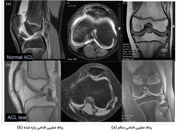 a) رباط صلیبی قدامی سالم b) رباط صلیبی قدامی پاره‌شده