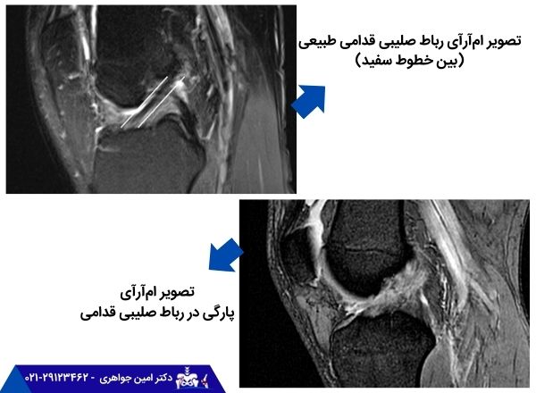 تصویر ام‌آرآی رباط صلیبی قدامی طبیعی (بین خطوط سفید) و تصویر ام‌آرآی پارگی در رباط صلیبی قدامی