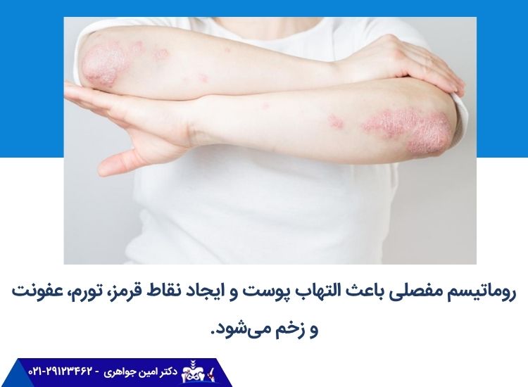 تأثیر روماتیسم مفصلی بر پوست