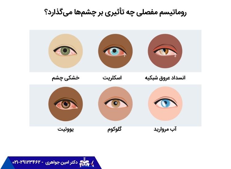تأثیر روماتیسم مفصلی بر چشم‌ها