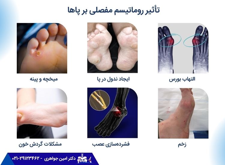 تأثیر روماتیسم مفصلی بر پاها