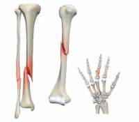 علت جوش نخوردن شکستگی استخوان چیست و چگونه درمان می شود؟