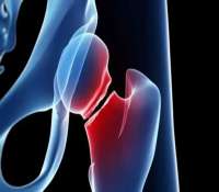 شکستگی مفصل هیپ چگونه درمان می شود؟
