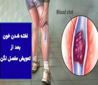 خطر آمبولی و لخته شدن خون بعد از تعویض مفصل لگن و پیشگیری از آن