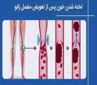 چرا آمبولی و لخته شدن خون بعد از تعویض مفصل زانو خطرناک است؟