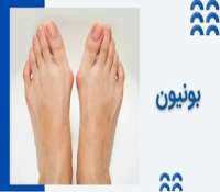 انحراف شست پا یا بونیون چیست و چطور درمان می شود؟
