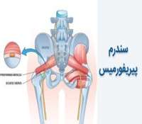سندرم پیریفورمیس و تاثیر آن بر درد لگن و کمر