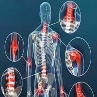  بیماری های مفصلی - انواع، علائم و درمان