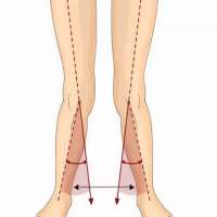 درمان پای ضربدری (زانوی ضربدری)‌ - حرکات اصلاحی