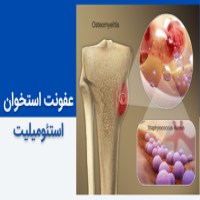عفونت استخوان (استئومیلیت) چیست؟ و چگونه درمان می‌شود؟
