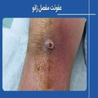 عفونت مفصل زانو چیست و چطور درمان می شود؟