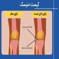 کیست منیسک چیست؟ علت، علائم و نحوه تشخیص و درمان