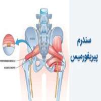 سندرم پیریفورمیس و تاثیر آن بر درد لگن و کمر
