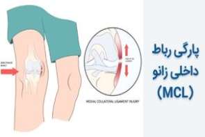 پارگی رباط داخلی زانو (MCL) - روش های تشخیص و درمان