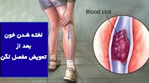 خطر آمبولی و لخته شدن خون بعد از تعویض مفصل لگن و پیشگیری از آن