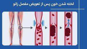 چرا آمبولی و لخته شدن خون بعد از تعویض مفصل زانو خطرناک است؟