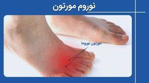 مورتون نوروما چیست و چطور درمان می شود؟