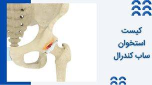 کیست‌ استخوان ساب‌ کندرال (SBCs) چیست و چطور درمان می شود؟