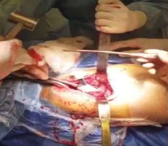عمل جراحی تعویض مفصل لگن