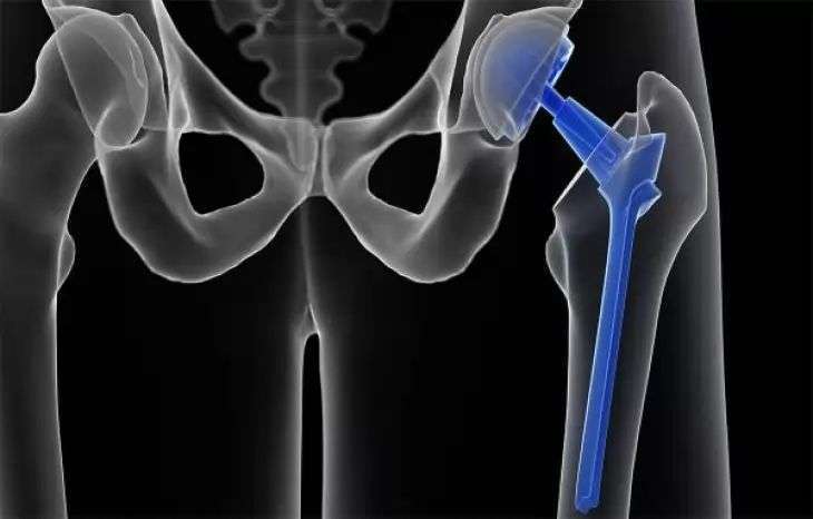 آرتروپلاستی مفصل ران یا هیپ برای چه بیمارانی انجام می‌شود؟