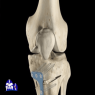 جراحی پای پرانتزی (استئوتومی) - هزینه، عوارض و نحوه عمل