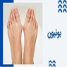 انحراف شست پا یا بونیون چیست و چطور درمان می شود؟
