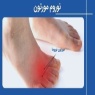 مورتون نوروما چیست و چطور درمان می شود؟